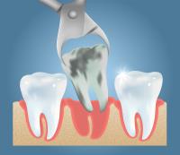 Wisdom Teeth Removal image 4